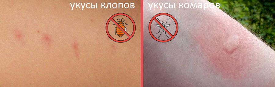 Укусы в кровати но не клопы